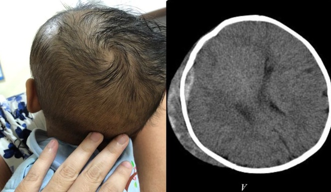 Bệnh nhi có ổ tụ máu ngoài màng cứng vùng thái dương - chẩm trái. Ảnh: BVCC.