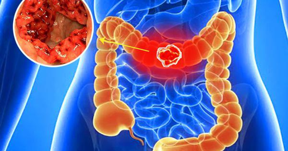 Sức khỏe đời sống - Chủ quan khi đi đại tiện, một người đàn ông suýt mất mạng