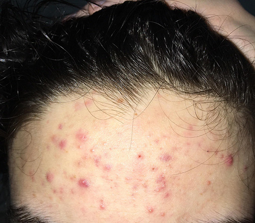 Nhìn cái trán đầy mụn này cũng hình dung ra cả mặt tớ thế nào rồi!