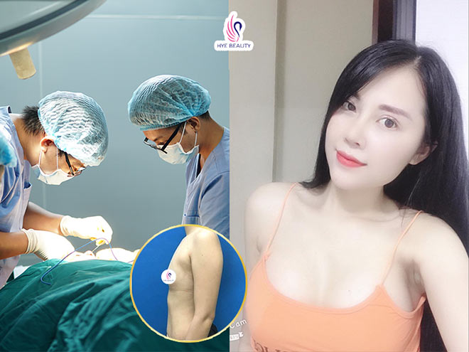 Hình ảnh khách hàng thực hiện dịch vụ PT Nâng V1 sau 1 tháng tại Khoa Phẫu thuật thẩm mỹ Bệnh viện An Việt Hye Beauty