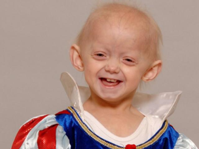 Sức khỏe đời sống - Bí ẩn căn bệnh cực kỳ hiếm gặp, khiến trẻ 3 tuổi trông như bà lão 80