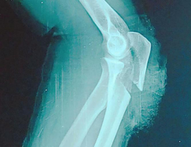 Cánh tay bị đứt gần lìa