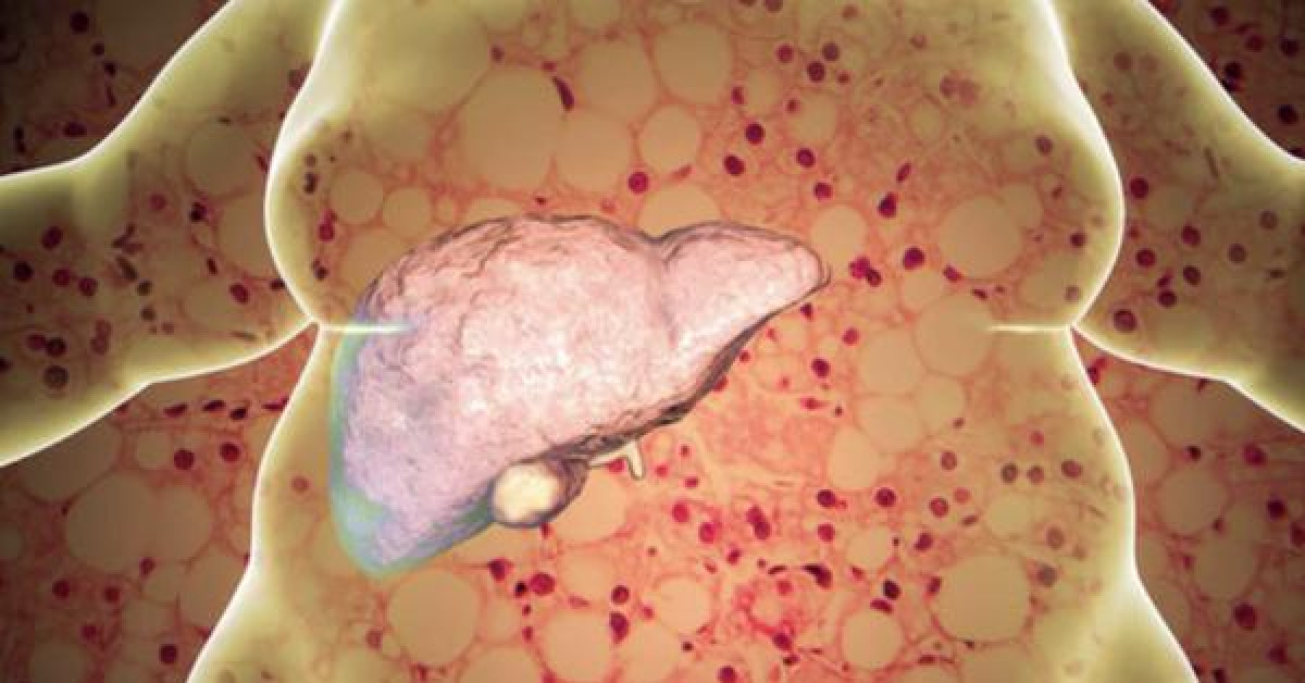 Sức khỏe đời sống - Từ vụ bé trai mới 8 tuổi đã bị gan nhiễm mỡ, chuyên gia chỉ rõ 5 nguyên nhân chính gây bệnh ở trẻ