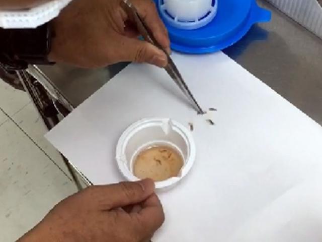 Sức khỏe đời sống - Ruồi chui vào tai người đàn ông đẻ trứng, bác sĩ gắp ra đầy giòi