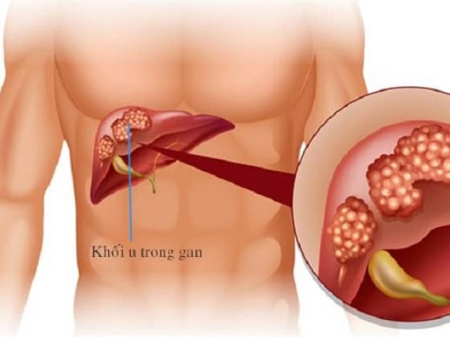 Sức khỏe đời sống - Nếu đau thắt lưng trái, có thể bạn đã bị u gan, cần đi khám ngay lập tức