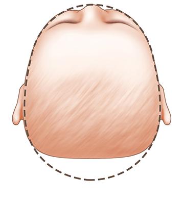 Tật đầu phẳng: dẹp phía sau (Brachycephaly- baby- head-shape)