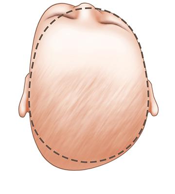 Dị tật đầu dính đường khớp lăm-da (Lambdoid- synostosis- baby- head-shape)