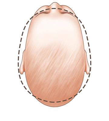 Dị tật đầu dính đường khớp dọc (Sagittal- synostosis- baby- head-shape)