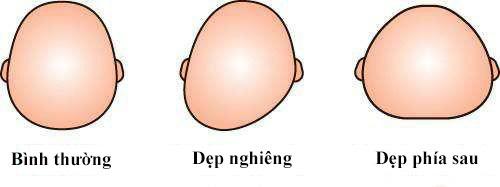 Hình dạng đầu trẻ bị tật đầu phẳng so với đầu trẻ bình thường