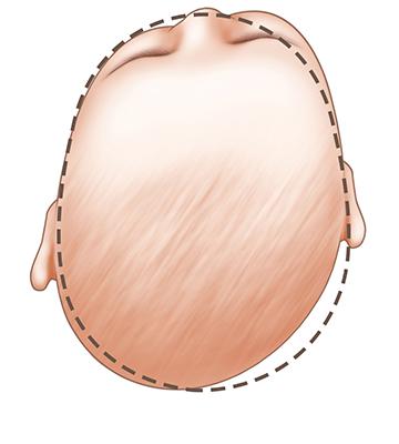 Tật đầu phẳng: đầu méo, dẹp nghiêng, một bên (Plagiocephaly- baby- head-shape)