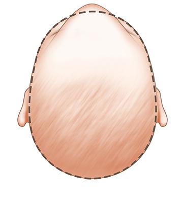 Dị tật đầu dính đường khớp trán (Metopic- synostosis- baby- head-shape)