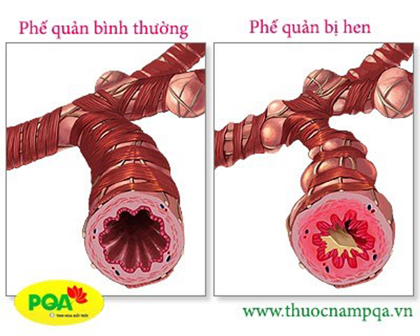 Cách nào đẩy lùi hen suyễn (hen phế quản) triệt để? - 1