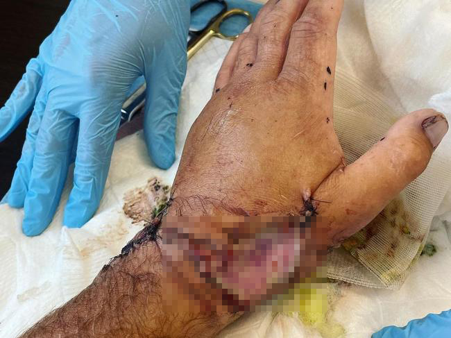Bàn tay bị thương của nam ngôi sao truyền hình Mỹ. Ảnh: Youtube