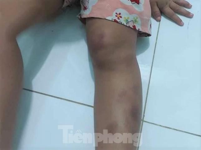 Cháu bé bị đánh thương tích đầy mình