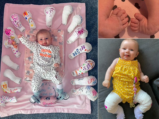 Bạn trẻ - Cuộc sống - Sinh ra đã có đôi chân khoèo, cô bé đã điều trị thành công đáng kinh ngạc