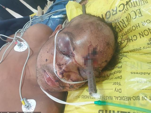 Phi thường - kỳ quặc - Ngửa đầu nhìn lên trời, người đàn ông bị thanh kim loại dài 6m đâm xuyên đầu