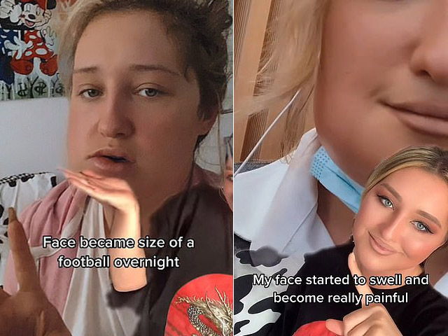 Bạn trẻ - Cuộc sống - Cô gái khốn đốn khi răng bị nhiễm trùng “biến dạng” mặt