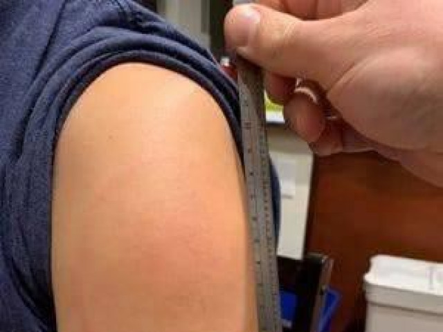 Sức khỏe đời sống - Vắc xin Moderna và phản ứng "cánh tay COVID"