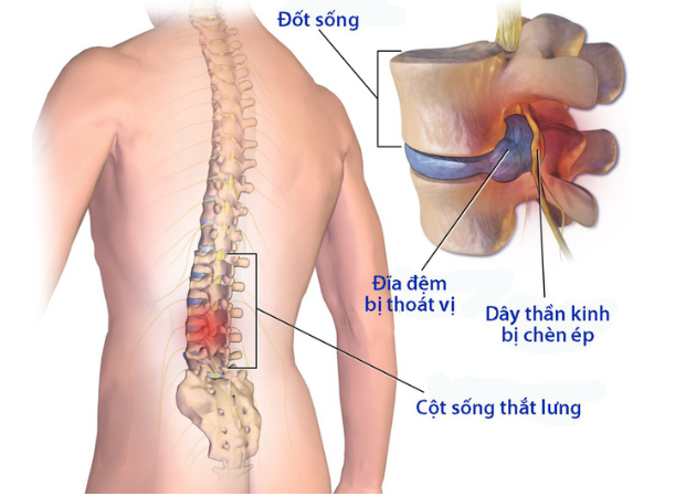 Cảnh báo đau nhức xương khớp đột nhiên tái phát cao mùa giãn cách - chớ coi thường! - 3