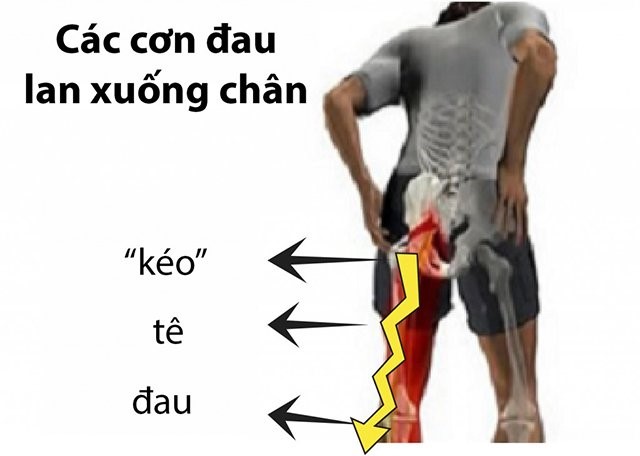 Đau khớp háng bên phải, trái và cách xử lý hiệu quả tư vấn bởi chuyên gia - 2