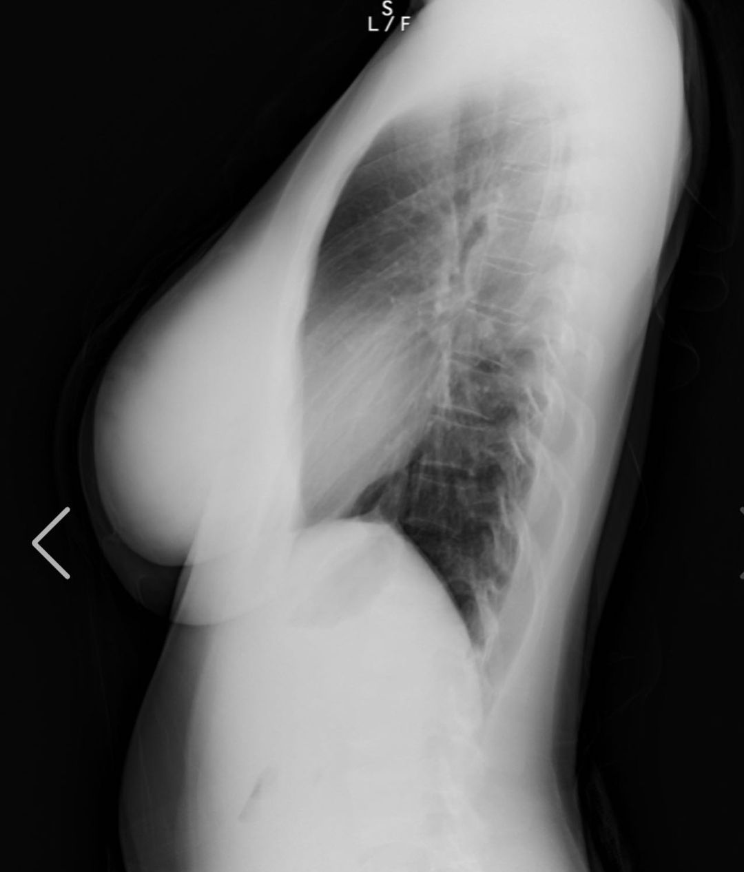 "Nấm lùn có vòng 1 đẹp nhất Nhật Bản" công khai ảnh X-quang chứng minh không sửa ngực - 5