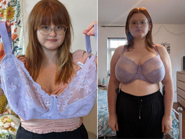 Bạn trẻ - Cuộc sống - Không thể chịu nổi bộ ngực "quá khổ", cô gái chi 200 triệu phẫu thuật thu nhỏ