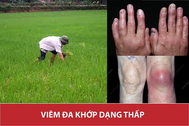 Mẹo giúp giảm đau viêm đa khớp ngón tay, ngón chân do làm ruộng - 2