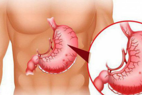 6 nhóm thực phẩm tàn phá dạ dày, người có dấu hiệu này tốt nhất không...