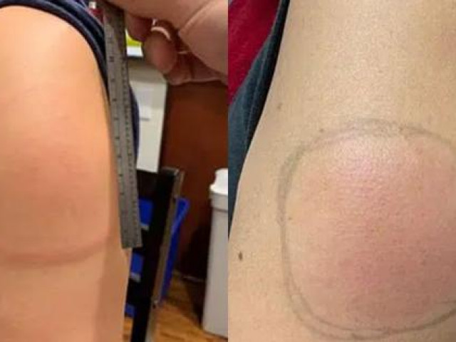 Tin tức trong ngày - Tại sao nhiều người xuất hiện triệu chứng "cánh tay COVID" sau khi tiêm vaccine?