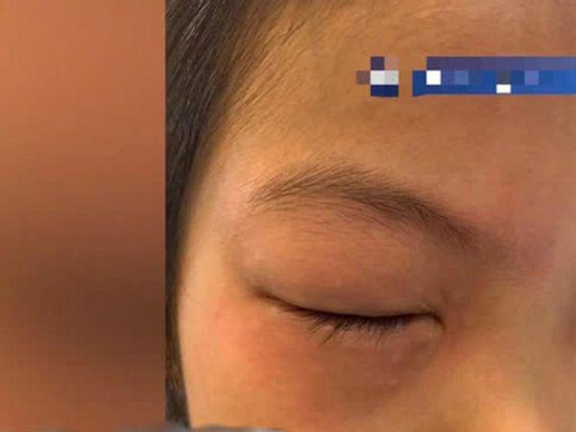 Bạn trẻ - Cuộc sống - Bé gái tiểu học sưng húp hai mắt vì mắc chứng dị ứng bài tập về nhà