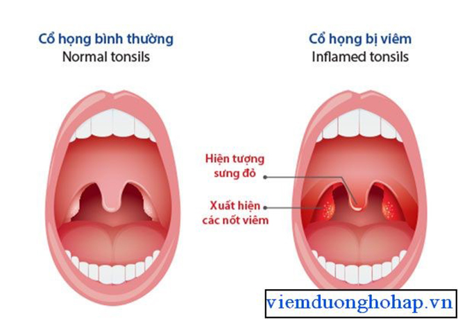 Tuyệt vọng vì đau rát họng, ho đờm dai dẳng, biết mẹo này mừng hơn bắt được vàng! - 3