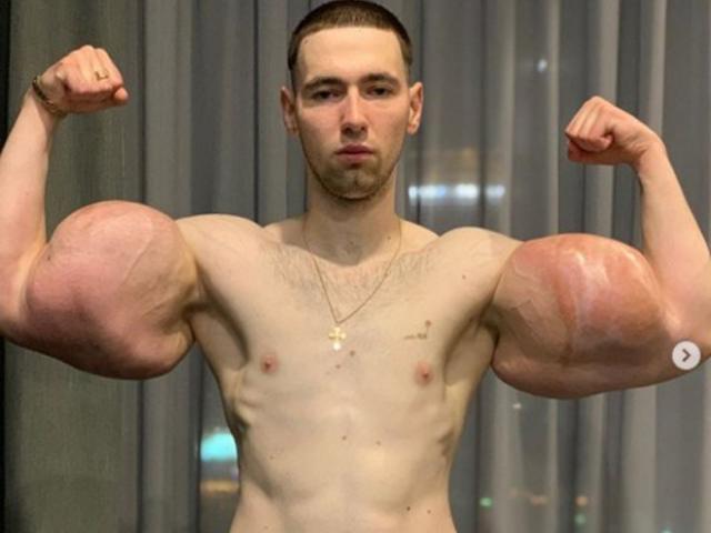 Thể thao - Kỳ dị lực sĩ có bắp tay hơn 60cm to như đùi, đấu MMA bị đánh "nổ cơ tay"