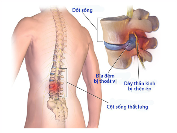 Người trẻ bị đau vai gáy, đau lưng liên tục - chuyên gia tiết lộ thủ phạm không ngờ! - 2