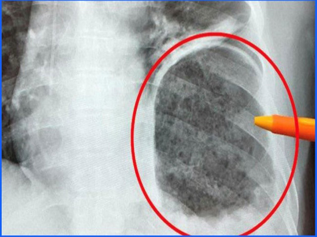 Sức khỏe đời sống - Tái phát đờm, ho, khó thở vào đêm và sáng sớm khi thay đổi thời tiết – hiểm hoạ khôn lường