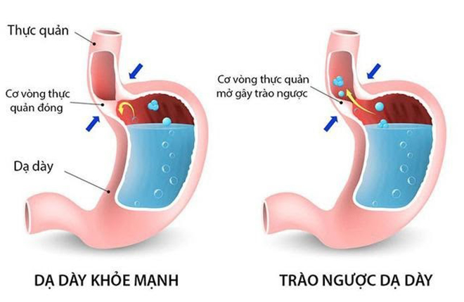 Bí quyết giúp thoát trào ngược và đau dạ dày cực đơn giản mà ít người biết - 2