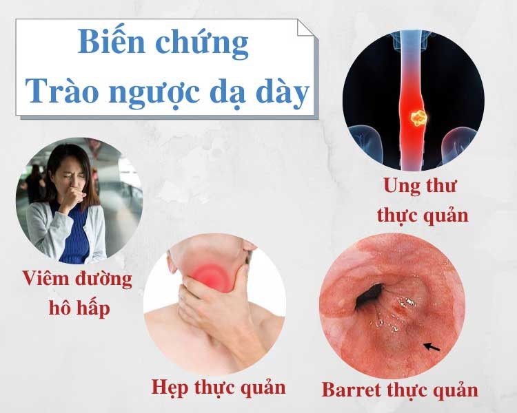 Trào ngược dạ dày nặng hay nhẹ: Làm theo cách này bệnh sẽ cải thiện ngay - 3