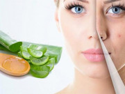 Làm đẹp - 12 cách trị mụn thâm từ thiên nhiên an toàn hiệu quả nhanh nhất tại nhà
