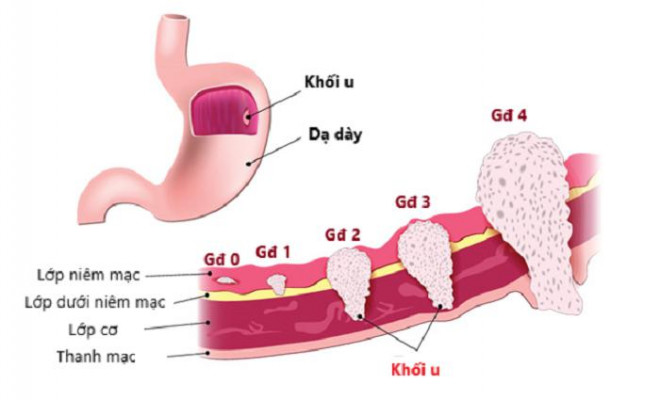 Cách phát hiện sớm ung thư dạ dày - 2