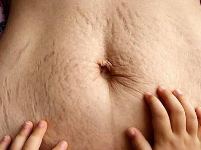 Sức khỏe đời sống - Hòa Minzy "khoe" bụng rạn sau sinh, chuyên gia chỉ cách phòng tránh rạn da ngay từ đầu để hạn chế hậu quả