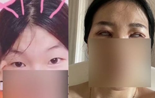 Cô Vương trước và sau khi phẫu thuật cắt mí có sự khác biệt rất lớn.