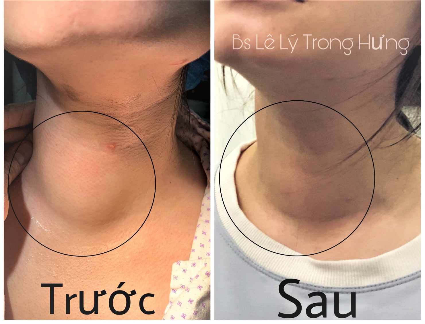 Kết quả điều trị sóng cao tần của bệnh nhân