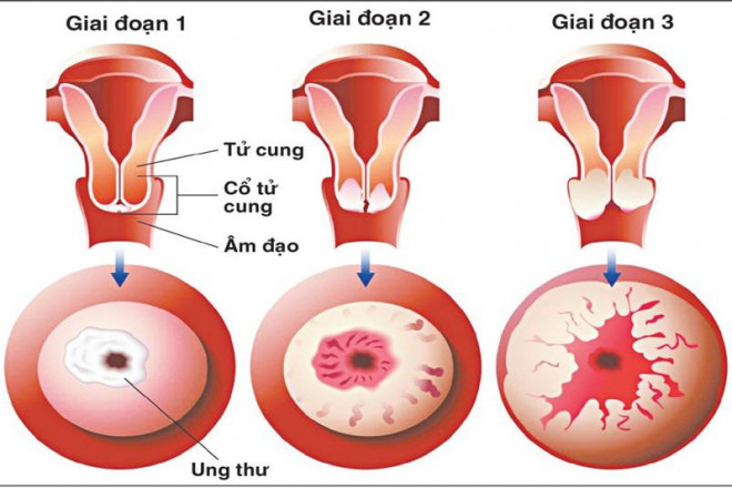 Hình ảnh giai đoạn ung thư cổ tử cung.