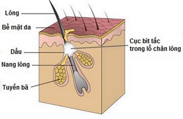 Cách làm sạch và ngăn ngừa tắc lỗ chân lông - 1