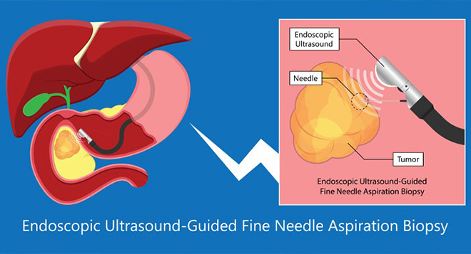 Chẩn đoán hình ảnh nâng cao - tầm soát ung thư chính xác hơn - 2