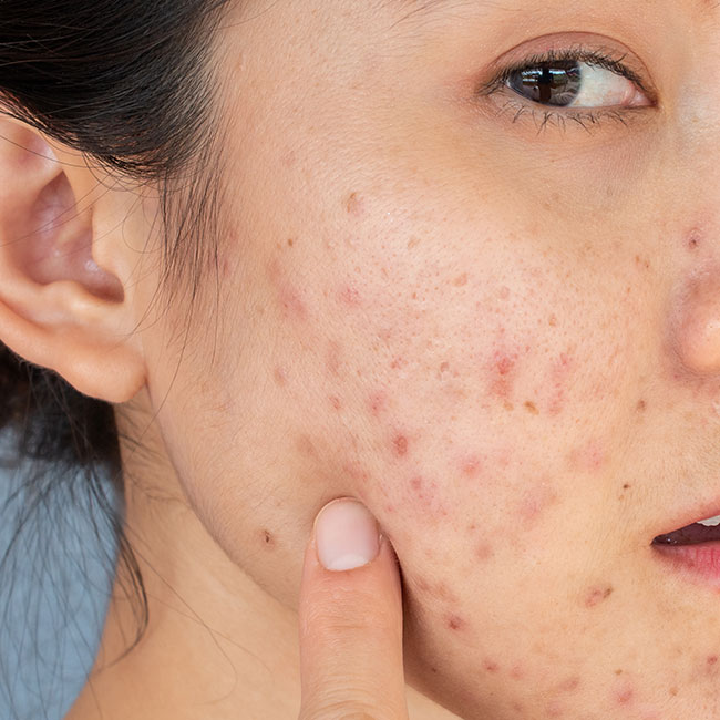 Sai lầm chăm sóc da dưới nắng hè khiến da xuất hiện đốm - 2