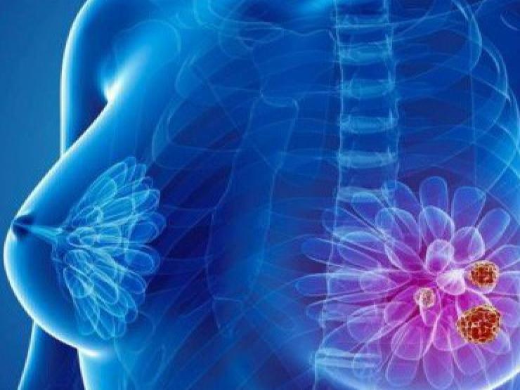 Sức khỏe đời sống - Bác sĩ Bệnh viện K “bật mí” 5 cách để phòng ung thư vú