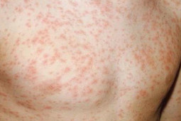 Sức khỏe đời sống - Hà Nội ghi nhận ca mắc sởi đầu tiên trong năm 2022