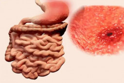 Sức khỏe đời sống - 3 nguyên nhân hàng đầu gây ung thư đại trực tràng, dừng ngay lại trước khi ruột già "kêu cứu"