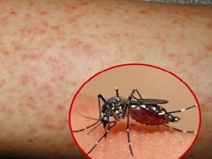 Sức khỏe đời sống - Sốt xuất huyết bùng phát: Cách nào phân biệt COVID-19 và sốt xuất huyết?