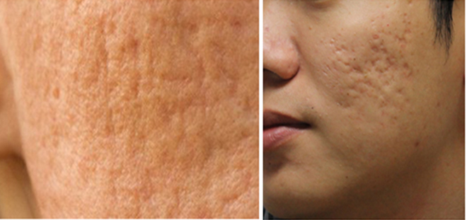 Serum mờ sẹo rỗ Hoa Kim làm đầy hõm sẹo rỗ tương đồng cơ chế tế bào gốc - 1
